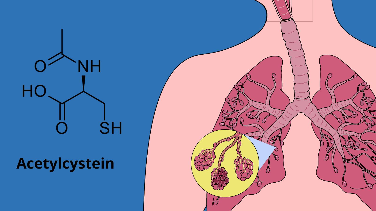 Acetylcystein là hoạt chất được ưa chuộng nhất dùng trong điều trị tiêu đờm